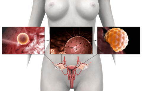 Ilustración de la fecundación humana que da inicio a la gestación: un óvulo se desprende del ovario, los espermatozoides intentan penetrar en el óvulo, el cigoto resultante de la fecundación se implanta en la pared del endometrio y comienza la división celular