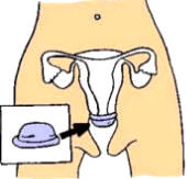 Métodos anticonceptivos - Colocación del diafragma