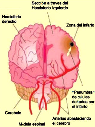 Dibujo mostrando un cerebro dañado por un infarto, así como la región de penumbra a su alrededor que puede sufrir daños posteriores.