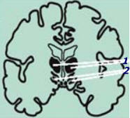 Sección coronal a través del cerebro mostrando el tálamo y el hipotálamo. 1-Tálamo, 2-Hipotálamo