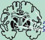 Sección coronal a través del cerebro mostrando los ganglios basales y el cuerpo calloso. 1-Hemisferio cerebral, 2-Cuerpo calloso, 3-Ganglios basales